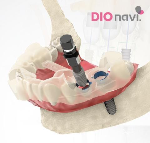 帝歐科技採用3D SYSTEMS的Projet 3510 DPPro 3D列印機，避免傳統做法誤差，大幅提升植牙精準度